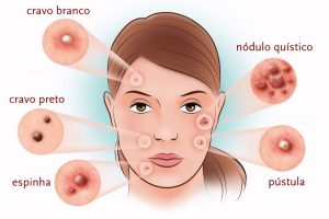Tipos de acne